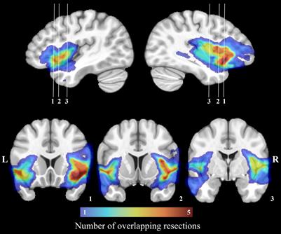 Progressive remodeling of structural networks following surgery for operculo-insular epilepsy